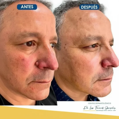 El Eliminador Definitivo de Verrugas - Bee Pure + REGALO GRATIS