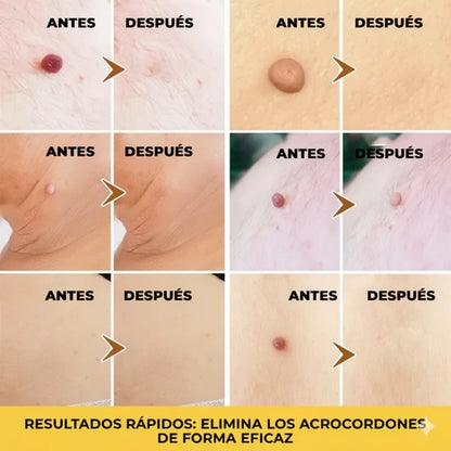 El Eliminador Definitivo de Verrugas - Bee Pure + REGALO GRATIS